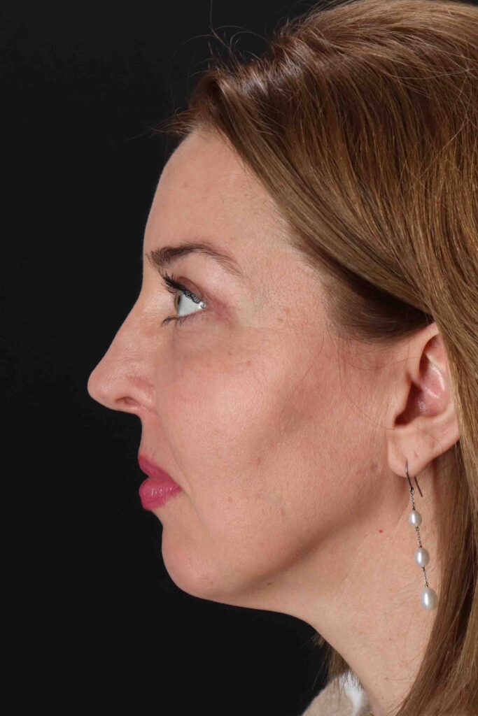 After - left_lateral