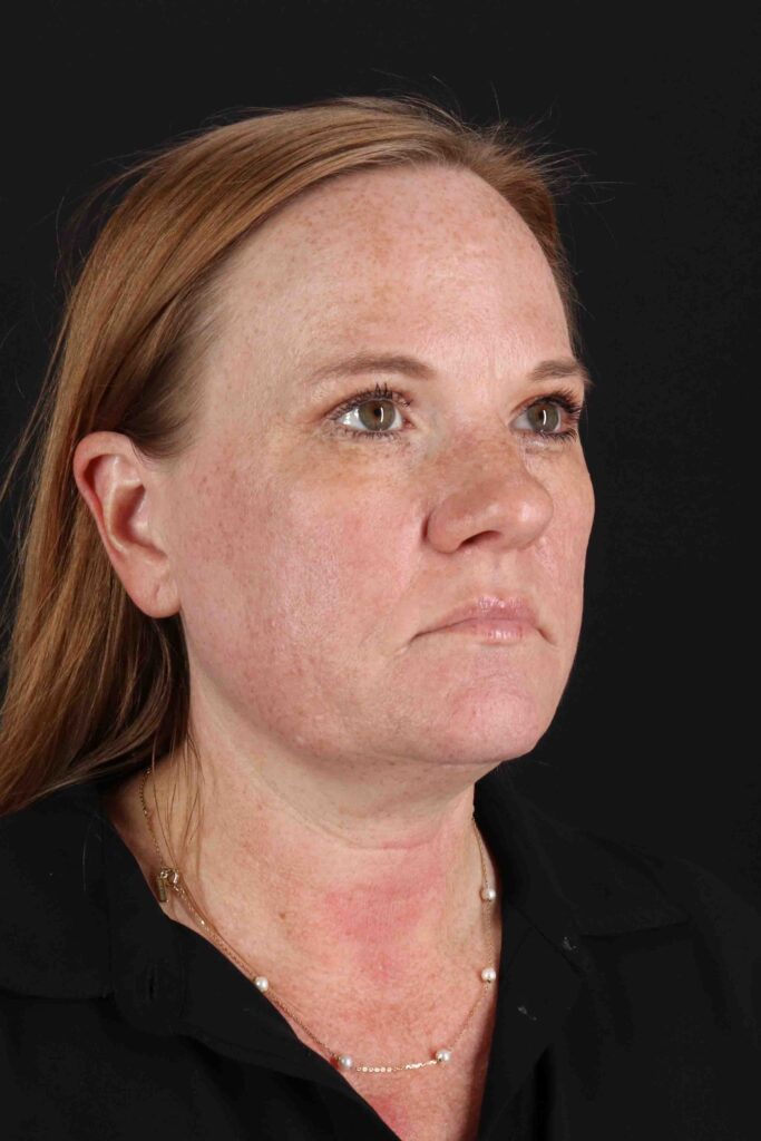 After - right_oblique