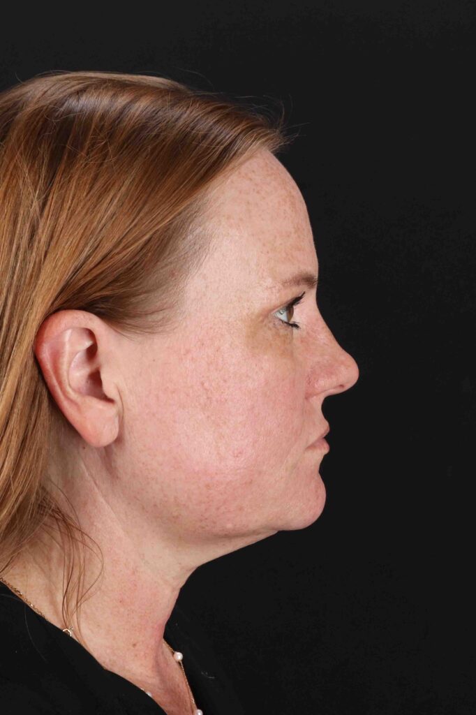 After - right_lateral