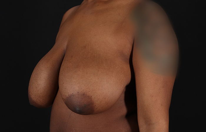 Before - left_oblique