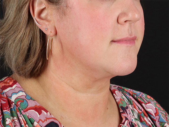 After - right_oblique