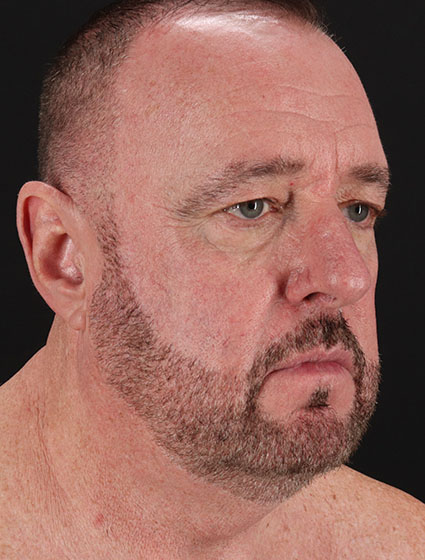 Before - right_oblique