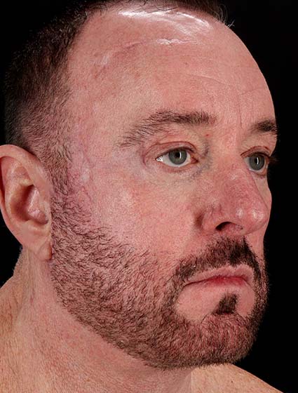 After - right_oblique