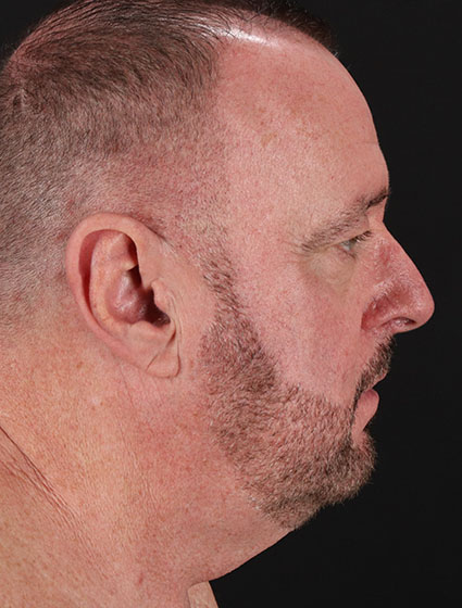 Before - right_lateral