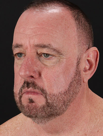 Before - left_oblique