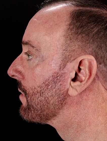 After - left_lateral