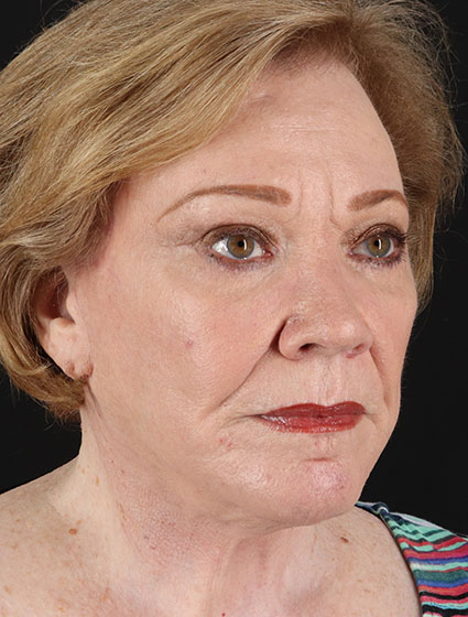 After - right_oblique