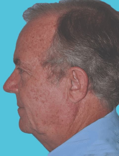 Before - left_lateral