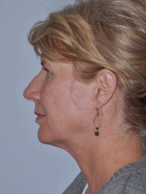 Before - left_lateral