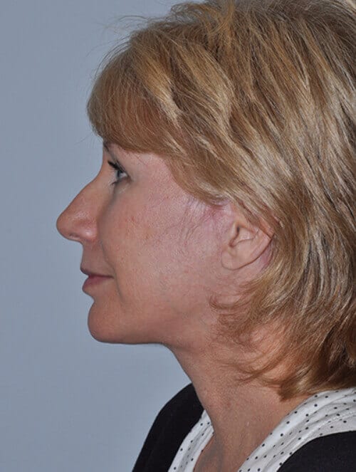 After - left_lateral