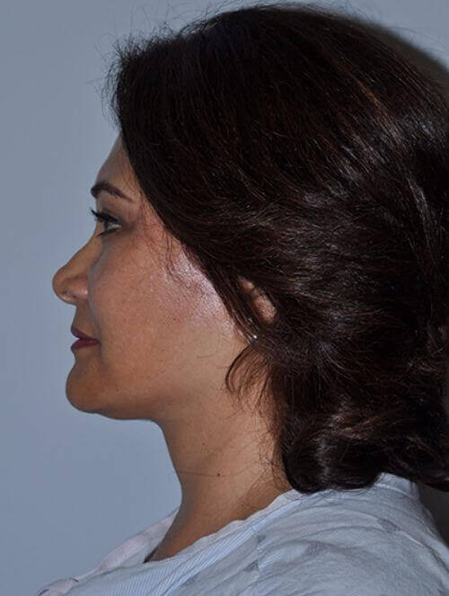 After - left_lateral