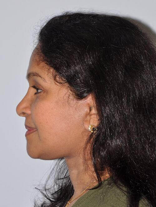 After - left_lateral