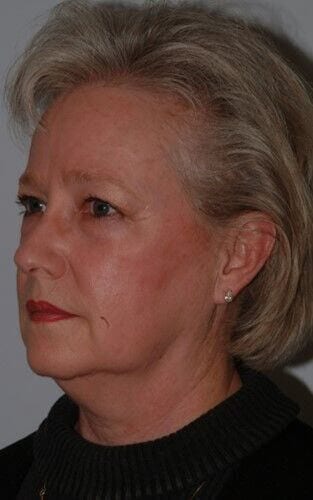 Before - left_oblique