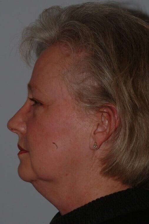 Before - left_lateral