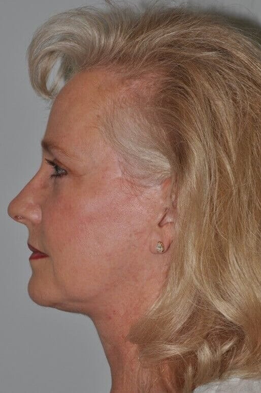 After - left_lateral