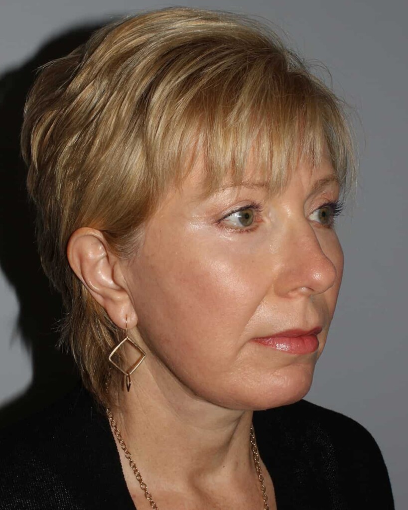 After - right_oblique