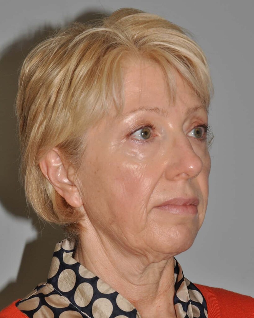 Before - right_oblique