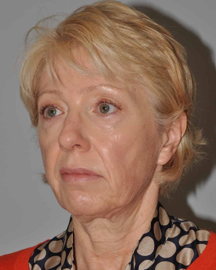 Before - left_oblique