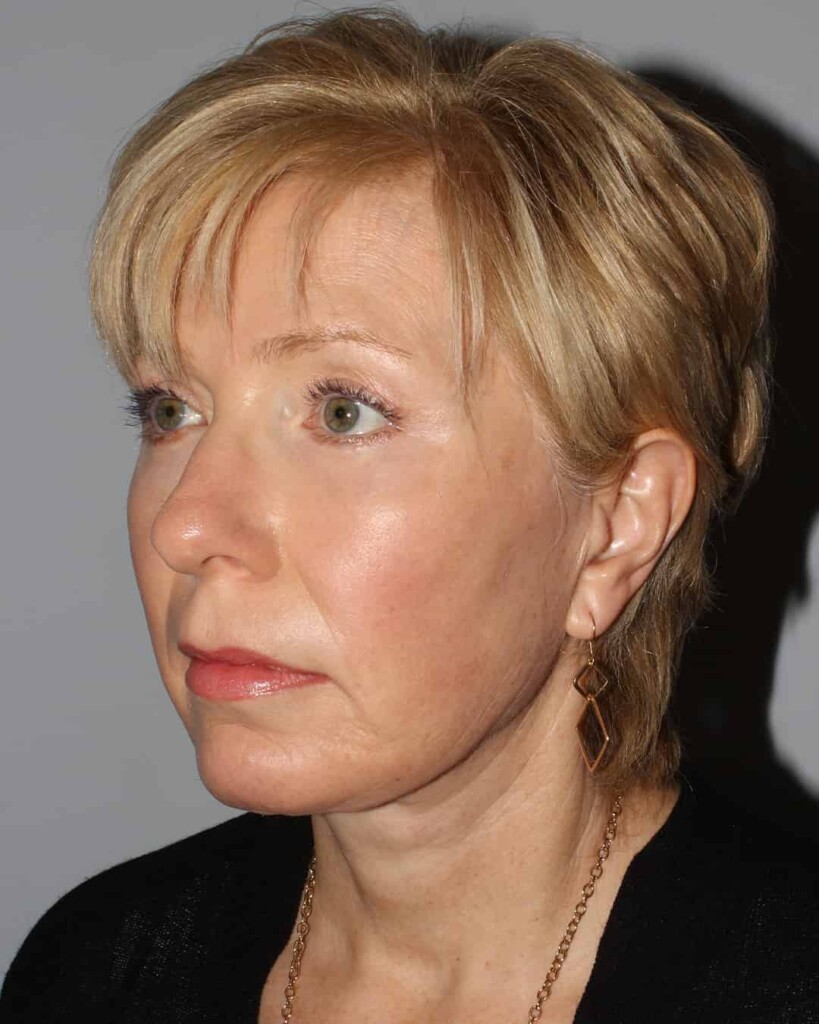 After - left_oblique