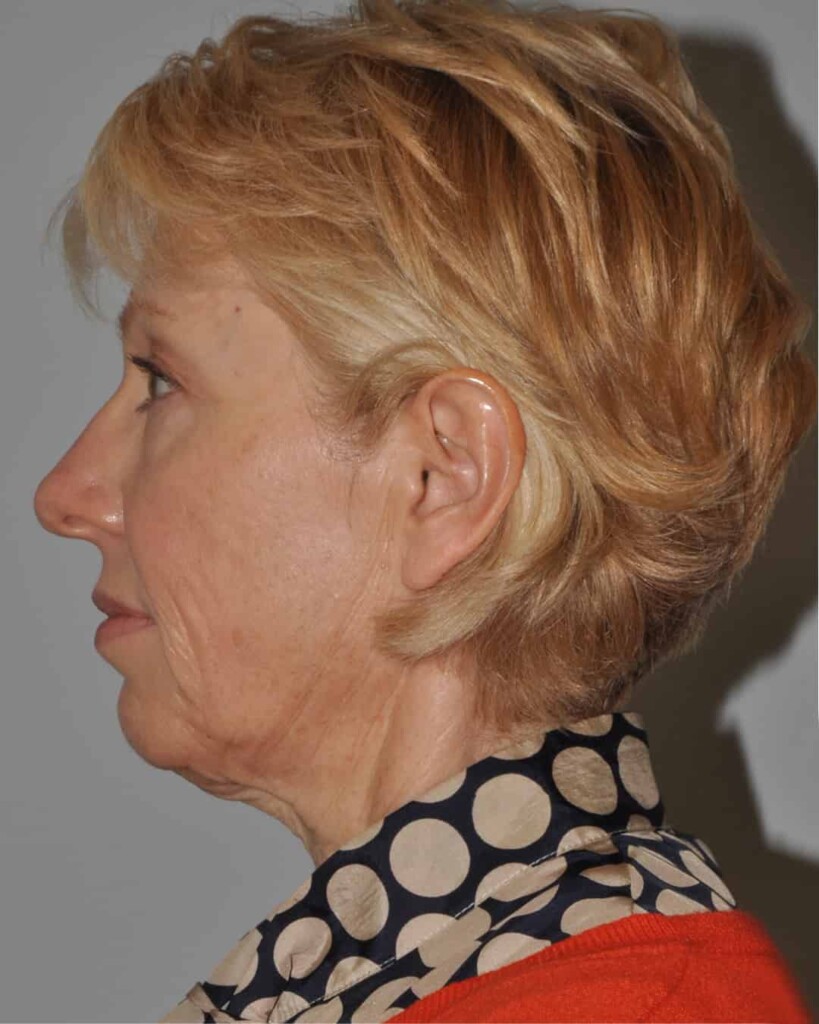 Before - left_lateral