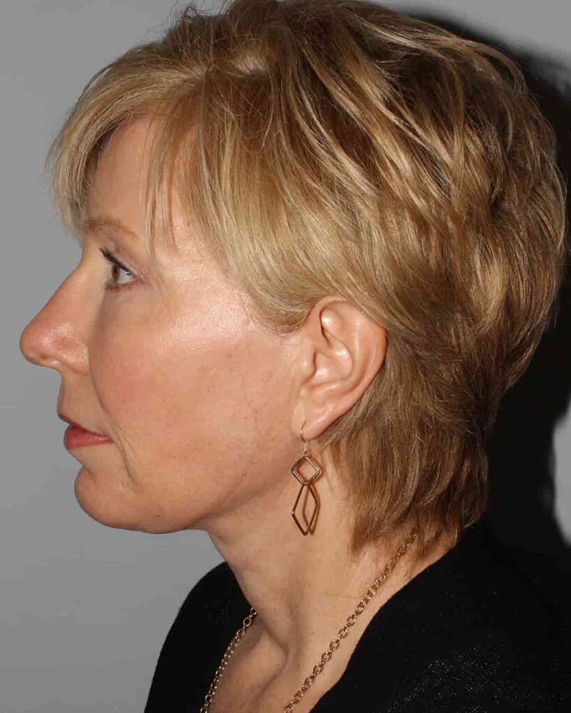 After - left_lateral