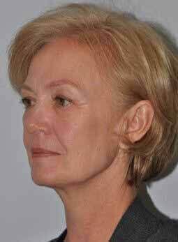 Before - left_oblique