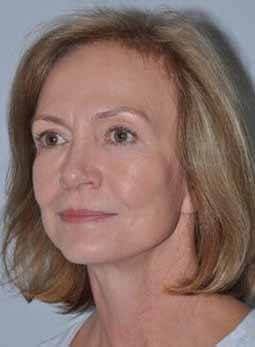 After - left_oblique