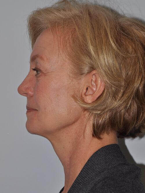 Before - left_lateral