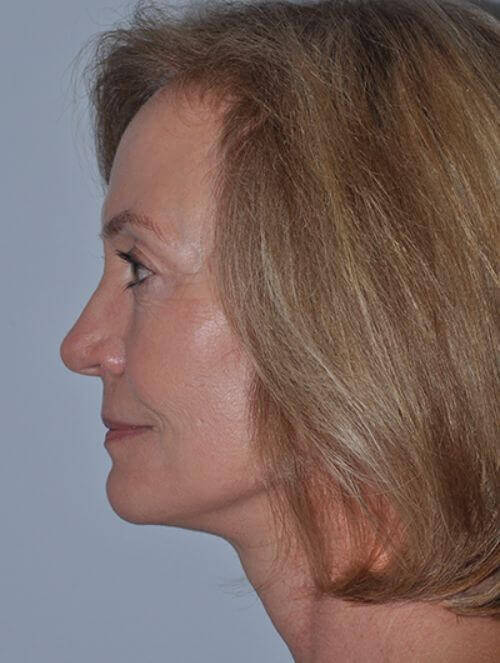 After - left_lateral