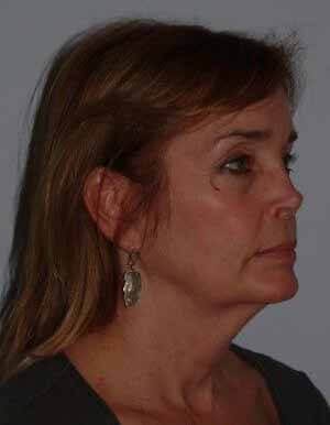 Before - right_oblique