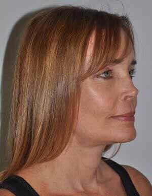 After - right_oblique