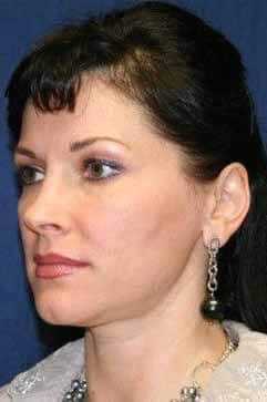 Before - left_oblique