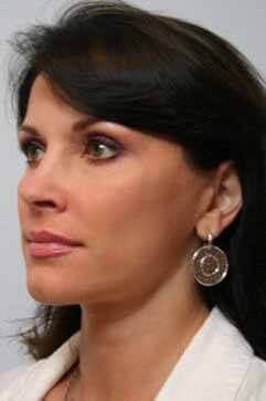 After - left_oblique