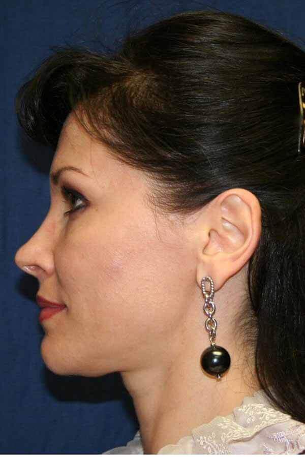 Before - left_lateral