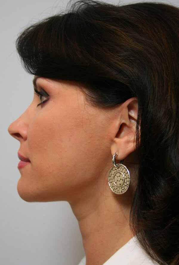 After - left_lateral