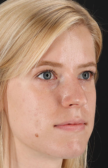 Before - right_oblique