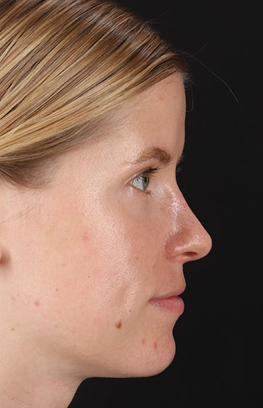 After - right_lateral