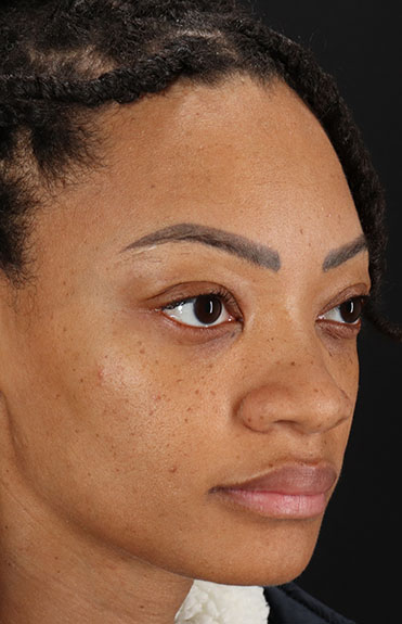 Before - right_oblique