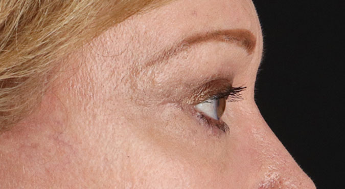 After - right_lateral