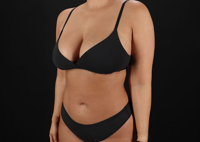 After - left_oblique