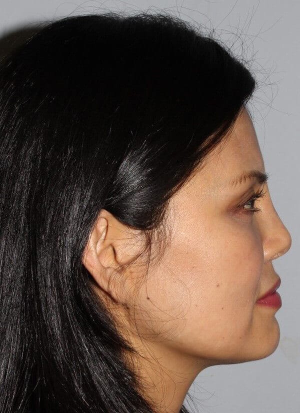 After - right_lateral