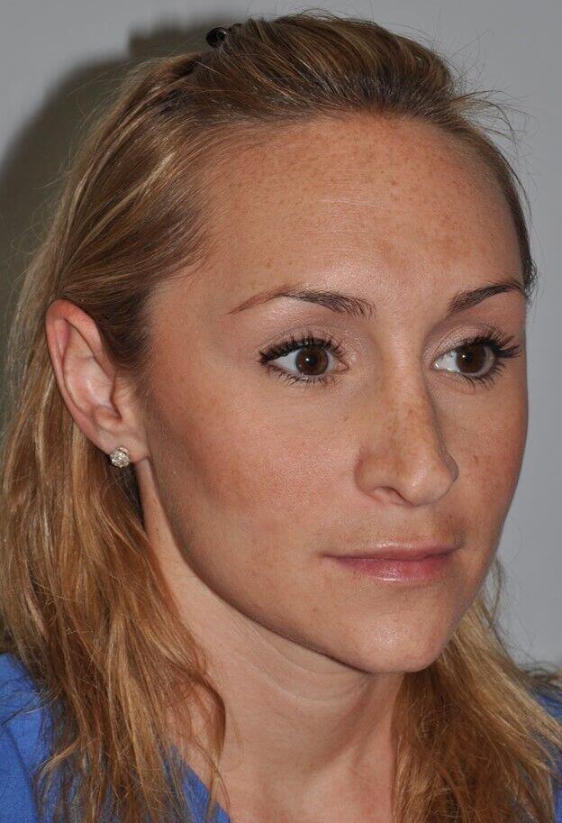 Before - right_oblique