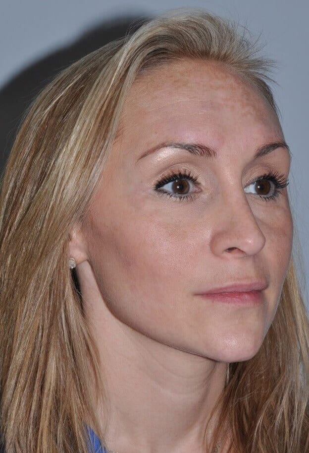 After - right_oblique