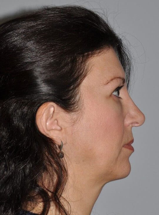 After - right_lateral