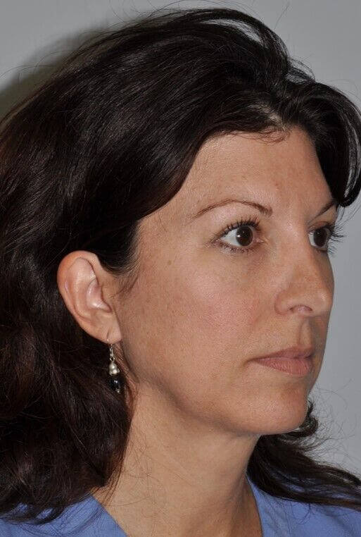 Before - right_oblique