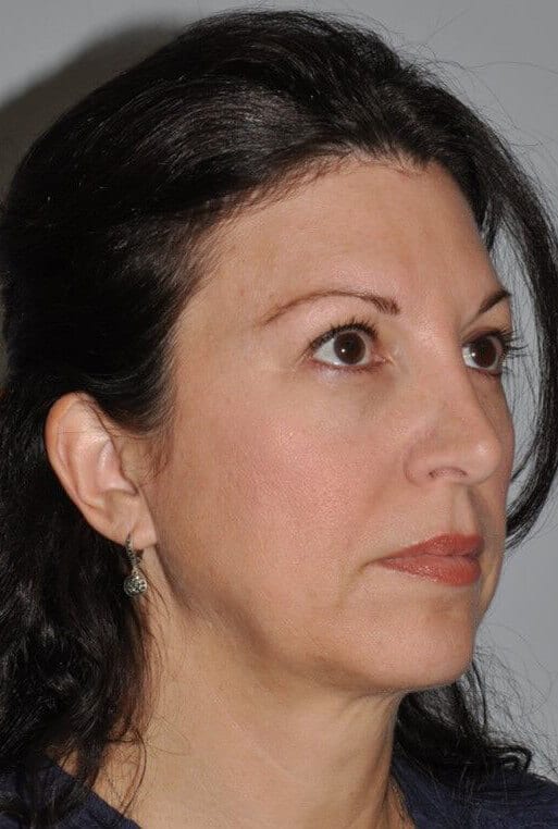 After - right_oblique