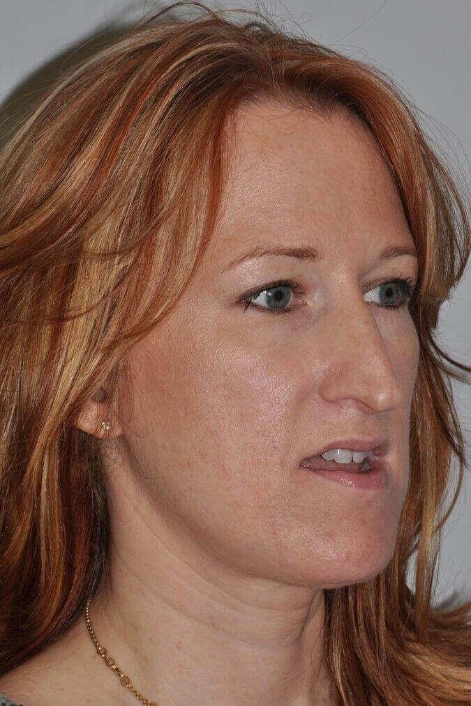 Before - right_oblique