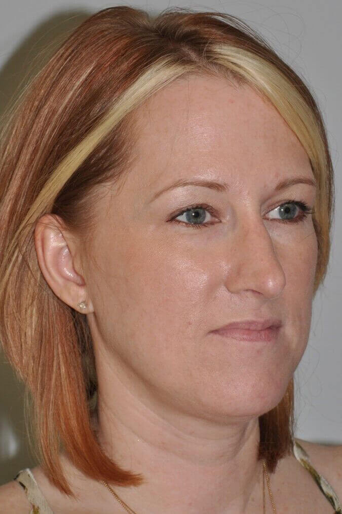 After - right_oblique