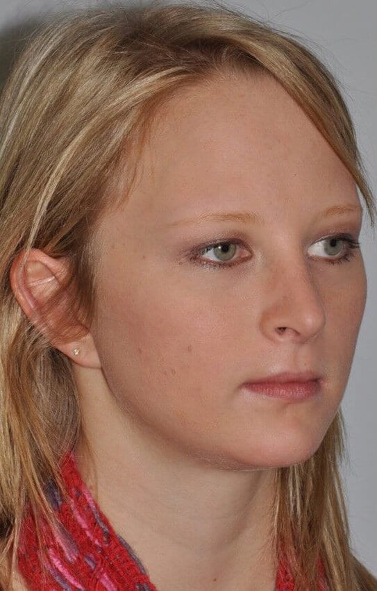 Before - right_oblique