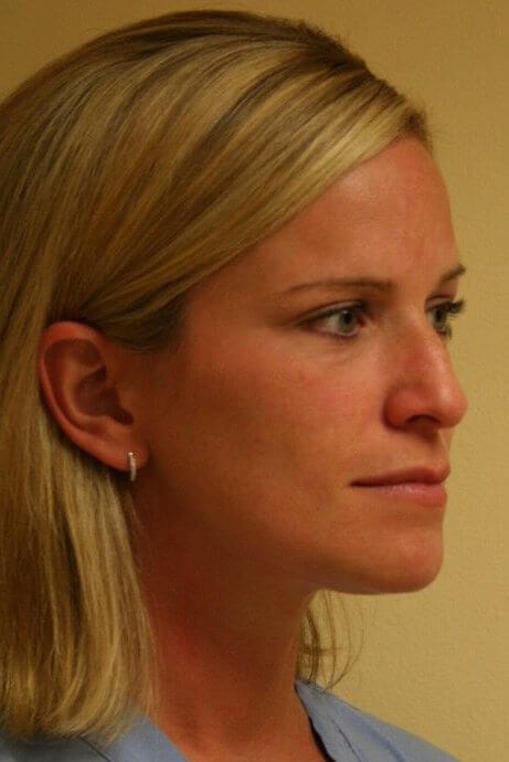 Before - right_oblique